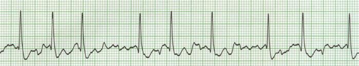 Educational Methodology Vent Rate: 72 P Duration: 82 ms PR Interval: 158 ms QRS