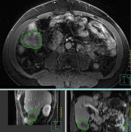 Treatment Planning: Liver SBRT 63 yo with HCC planned for liver SBRT T1
