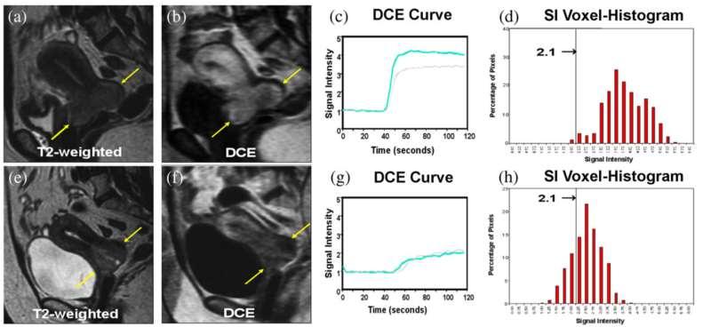 Treatment Response: GYN Functional (DCE) MRI used to predict response to definitive chemort for