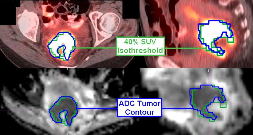 FDG-PET/ADC-MRI Concordance