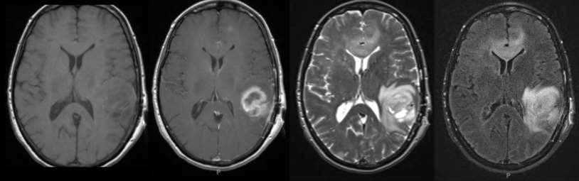 Treatment Planning: CNS T1 pre T1 post T2 T2 FLAIR High grade tumors typically contrast