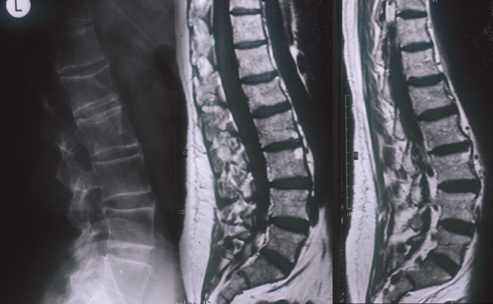 Fat accumulation and syndesmophytes in AS (MRI) The fatty Romanus lesion (FRL) a non-inflammatory spinal MRI