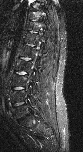 Spinal inflammation lesions as detected by MRI in patients with early AS are more often observed in posterior spinal