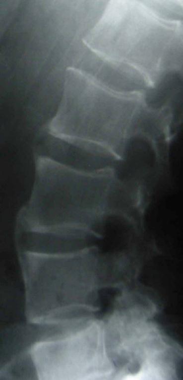 thoracic excursion (< 3cm) Radiologic Criterium Sacroiliitis > grade II bilat. or > grade II unilat.