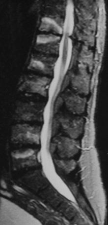 Axial spondyloarthritis including AS (inflammatory) back pain Stage 1