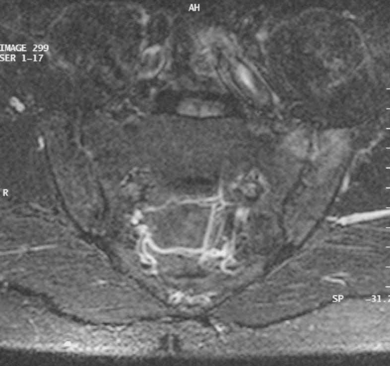 Extended inflammation in the sacroiliac joints predicts development to AS (MRI and HLA-B27) sacroiliitis with large bone marrow edema Sensitivity and specificity 77 %