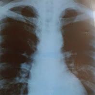 Slika 1. Rentgen srca i pluća Pacijent je upućen pulmologu. Urađena je spirometrija čiji su rezultati bili u granicama normale i pulmolog je predložio nastavak antibiotske terapije.