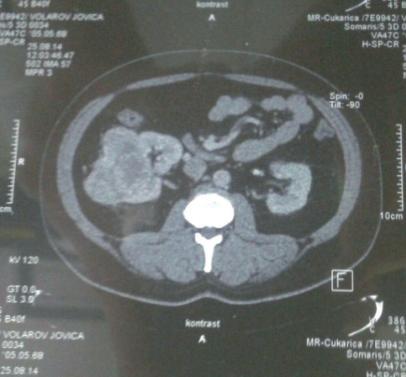 Slika 3. MDCT abdomena (strelicom obeležen tumor) Pacijent je upućen urologu sa radnom dijagnozom karcinoma bubrežnih ćelija i urolog je indikovao operativno lečenje.