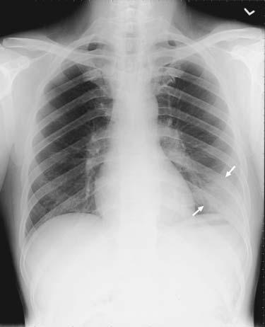 A C B Figure 2. Frontal Chest Radiographs in a 46-Year-Old Man.