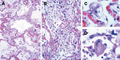 A B C D Figure 4. Lung-Biopsy Specimen Obtained at Autopsy. Panel A shows diffuse alveolar damage with pulmonary congestion, edema, and formation of hyaline membrane (hematoxylin and eosin, 100).