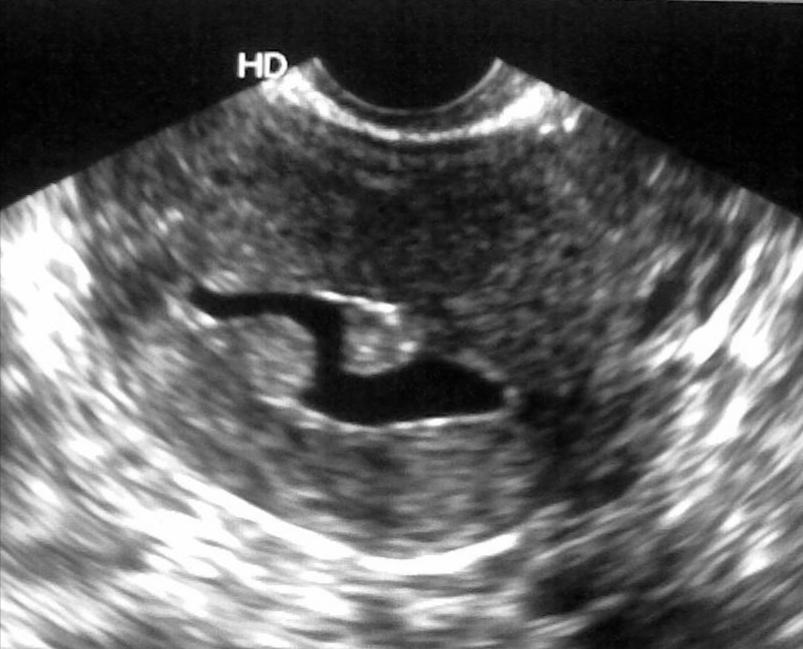 14 focal lesions and 15 diffuse lesions were found in sonohysterography. The focal lesions diagnosed in SHG were the following.
