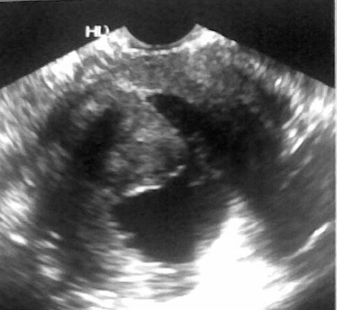 Endometrial polyps 9 64% Submucosal fibroids 4 29% Retained products of conception 1 7% Table1 showing focal lesions diagnosed by