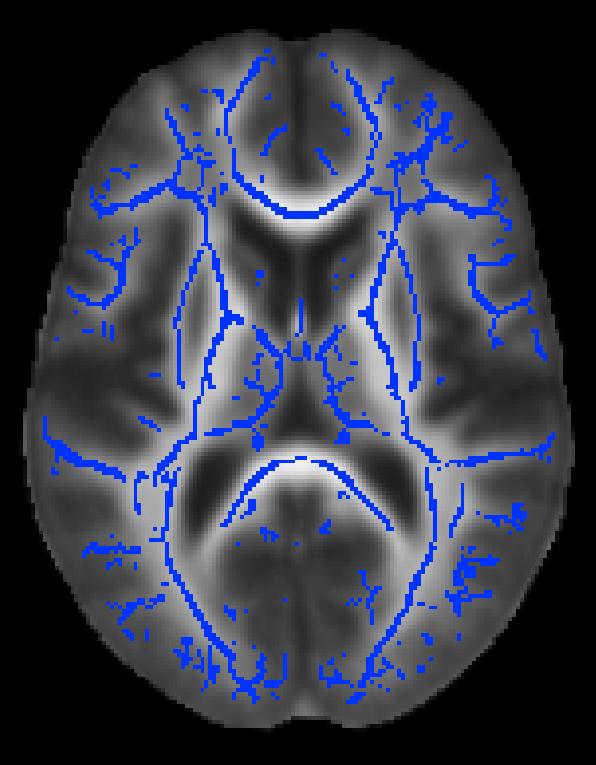 Tract Based Spatial Statistical (TBSS) Approach to DTI analysis Smith et al (2007) identifies center of each white matter