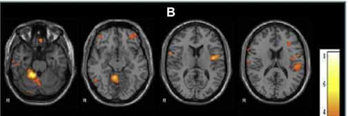 Sensorimotor network revealed by functional MRI Faivre et al, J Clin Neuroscience (22) 2015:1438-1443 Intrinsic Connectivity