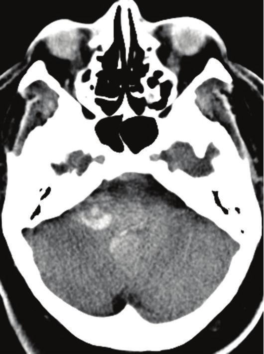 2 Case Reports in Radiology Figure 1: Axial and coronal noncontrast computed tomography (CT) of the head demonstrates hemorrhage in the region of the inferior right cerebellar peduncle, which