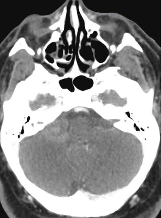 The right posterior inferior cerebellar artery (PICA) is not well seen (arrow in indicates the normal left PICA) and may be compressed by surrounding hemorrhage, involved with vasospasm or thrombosed.
