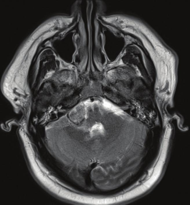 Case Reports in Radiology 3 (c) (d) Figure 3: Axial T2-weighted as well as axial and coronal (c) T1-weighted contrast-enhanced magnetic resonance imaging (MRI) of the brain demonstrates an enhanced