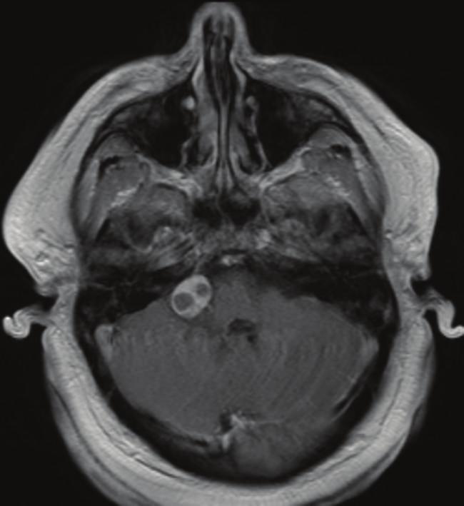 One year after resection, axial 3D T1-weighted contrast-enhanced MRI of the brain (d) demonstrates interval postsurgical changes of right retromastoid craniotomy for resection of the right