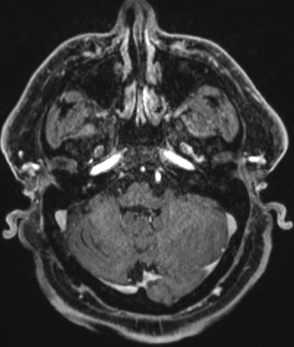 Additionally, while GLUT-1 is typically positive in infantile and juvenile hemangiomas, it was negative in this case given the patient s adult age.