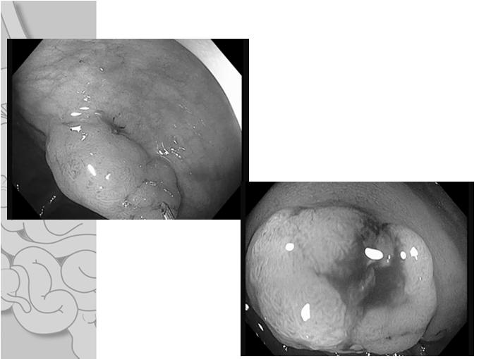 of Very Large Lateral Spreading Polyp by