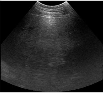 Fig. 3: Ultrasonogram of grade 2 fatty infiltration; bright pattern, vessel blurring and deep attenuation are present
