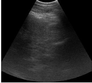 4: Ultrasonogram of grade 3 fatty infiltration; bright pattern, vessel blurring and deep attenuation are present and