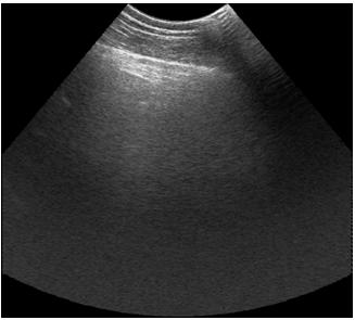 5: Ultrasonogram of grade 3 fatty infiltration; hyperechogenisity of nearfield and a dark shadow behind it are present