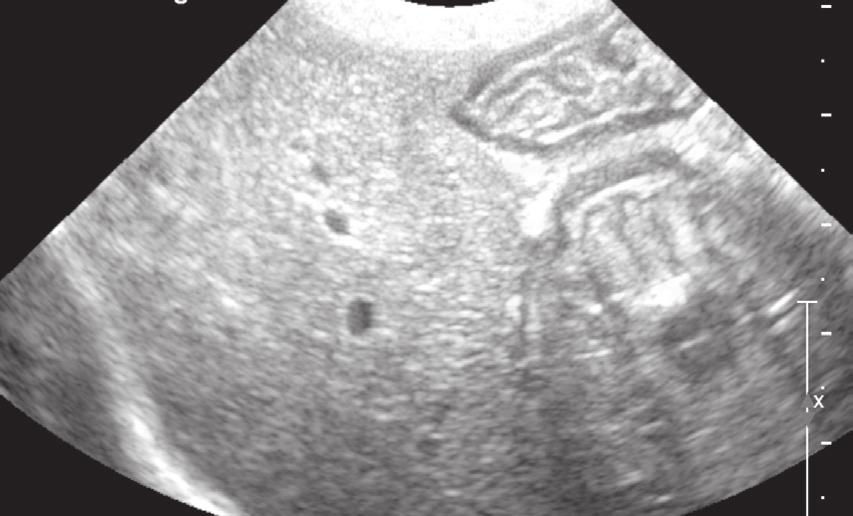 The initial articles provided an overview of basic ultrasonography principles and a discussion about how to perform a sonographic tour of the abdomen.