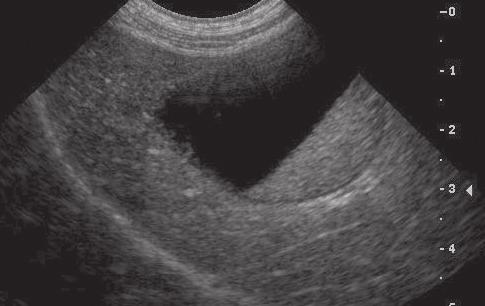 Hypoattenuation describes areas that do not attenuate the ultrasound waves, resulting in artifact and distal acoustic enhancement, and the area deeper to the cystic structure appears whiter on the