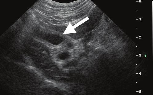 IMGING ESSENTILS Peer Reviewed ILIRY NORMLITIES The gallbladder is normally found to the right of midline surrounded by the hepatic parenchyma.