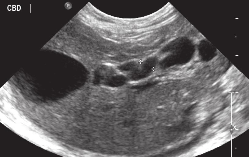 The dilated intrahepatic ducts can be seen around the portal veins within the hepatic parenchyma (Figure 15).