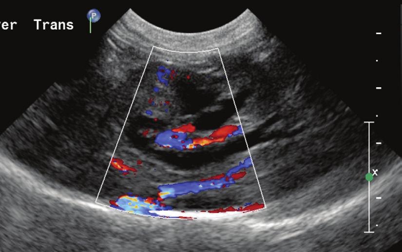 Long-axis, right-sided liver image in a cat in which a distal biliary mass has obstructed the bile duct (). The bile and cystic ducts are dilated (> 3 mm) and tortuous.