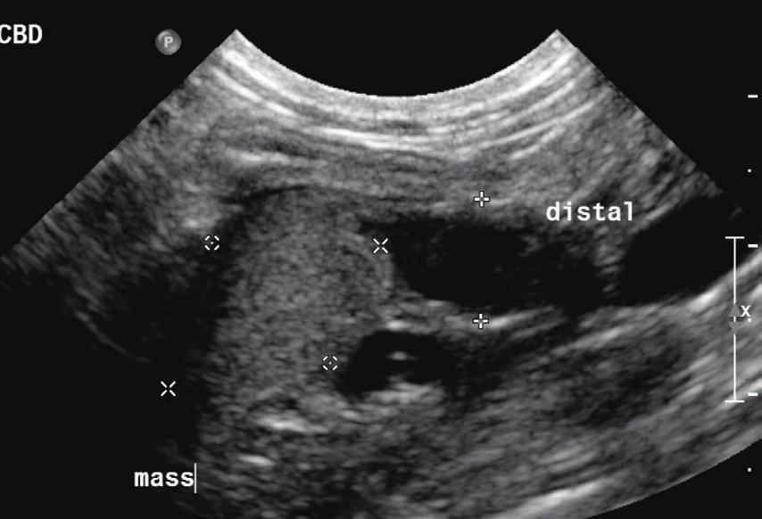 The color Doppler image documents normal flow within the hepatic and portal veins. The biliary ductal dilation is seen without flow in the liver.