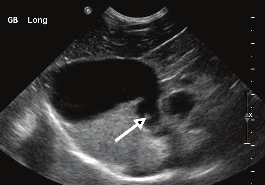 Other causes of extrahepatic biliary obstructions include choleliths, duodenal strictures at the major duodenal papilla, and biliary tumors (Figure 16). FIGURE 16.