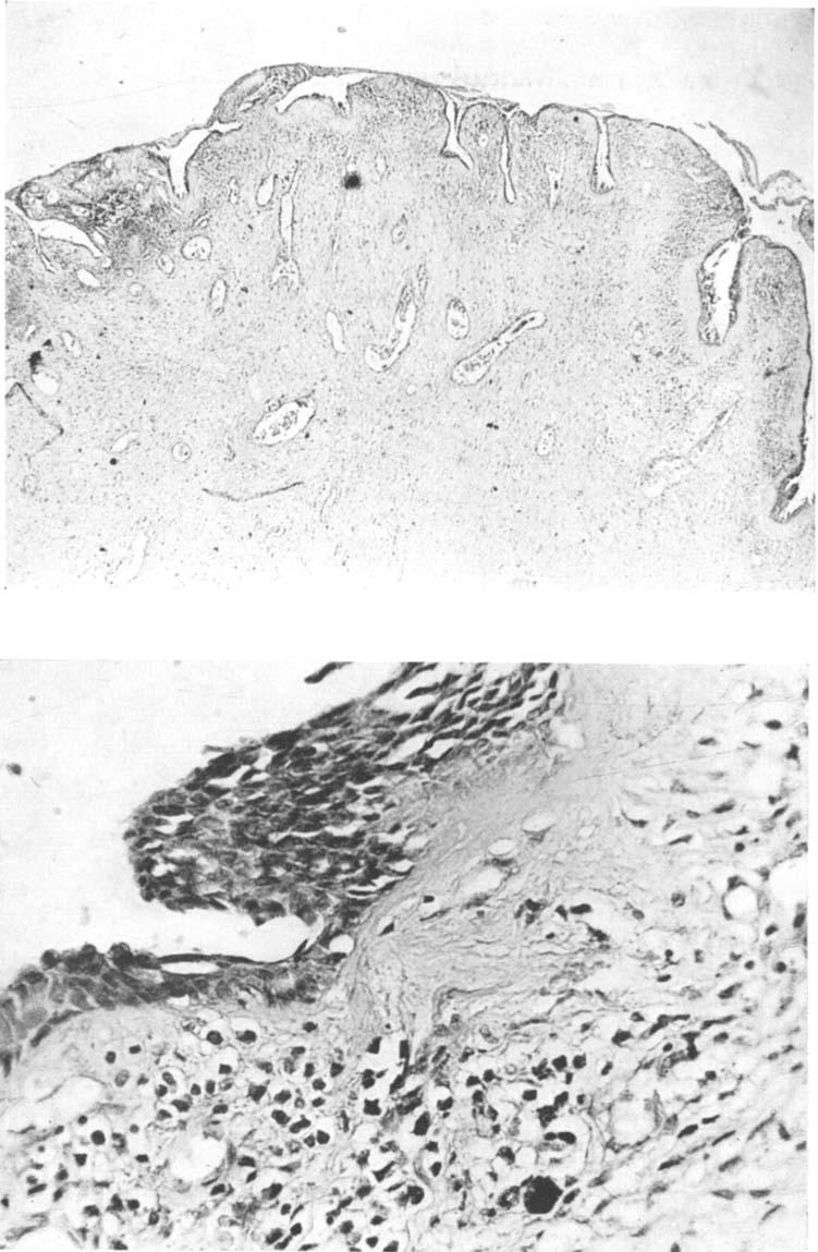 CASE REPORT: A FIG. 3. (A) Low-power view of the polyp showing thin, atrophied epithelium and inflammatory tissue.