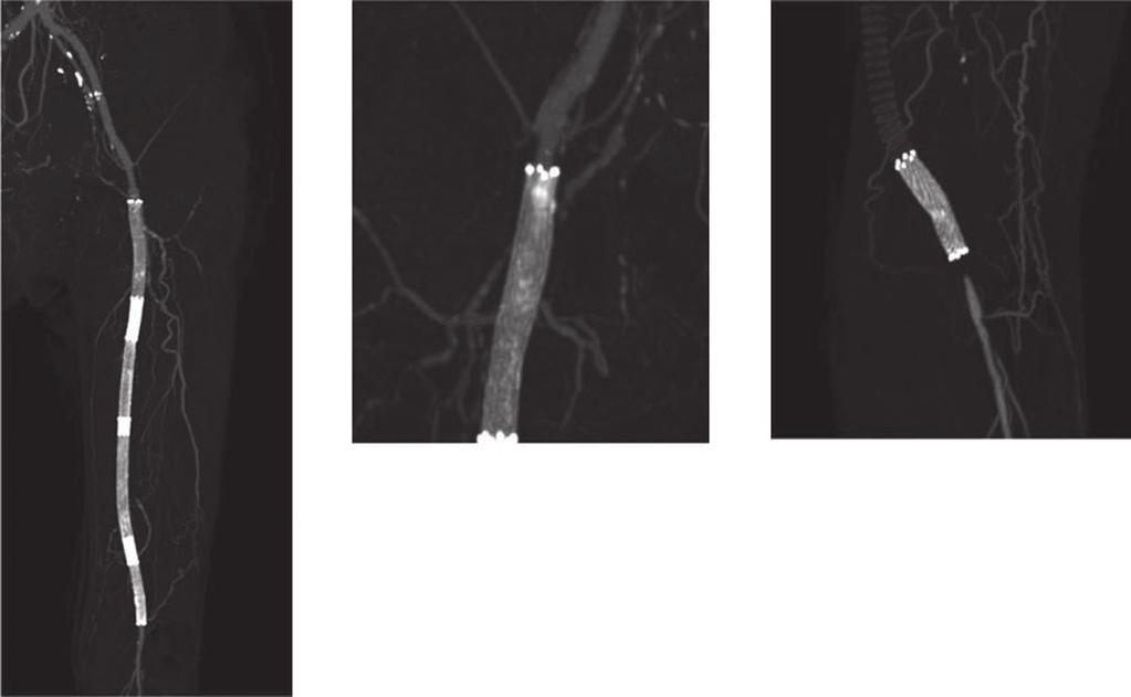 4 Popliteal artery stent fracture in the region of knee joint flexion (arrows).