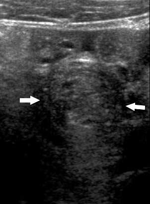 Sonographic Whirlpool Sign in Ovarian Torsion Figure 4. Twisted pedicle appearing as a large hypoechoic mass (arrows). The rings are not obvious.
