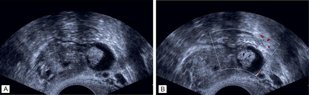 Figure 1. Transvaginal ultrasound images of case 3. A. The parovarian unilocular hypoechoic cyst was close to but separate from the ipsilateral ovary.