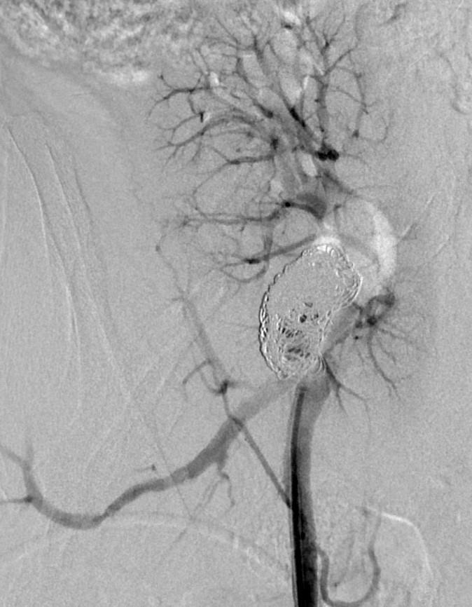 CASE 2: PA Follow-up angiogram one month later demonstrated persistent but diminished flow within the PA. Fig 6.