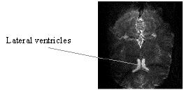 8). The frontal and parietal lobes are separated by the central sulcus, and the temporal lobe separated by the lateral fissure. The corpus callosum joins left and right hemispheres. Figure 3.