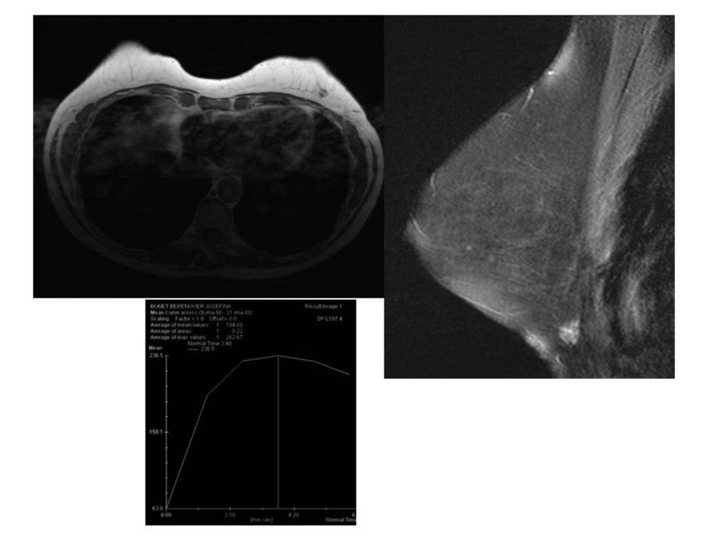 Fig. 8: Espiculated hyperintense lesion in inferior external