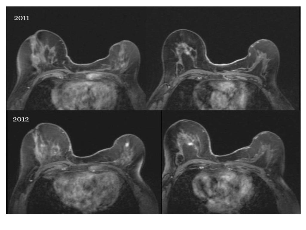 Fig. 10: First MRI shows a well defined hyperintense lesion in right breast.