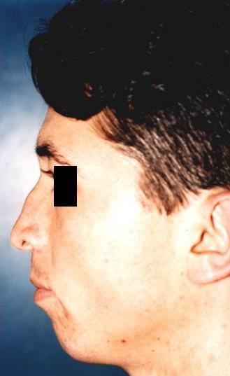If the surgeon reduces the nasal hump just to fulfill the request, due to the anatomic imbalance, lower nose now appears even larger [4].