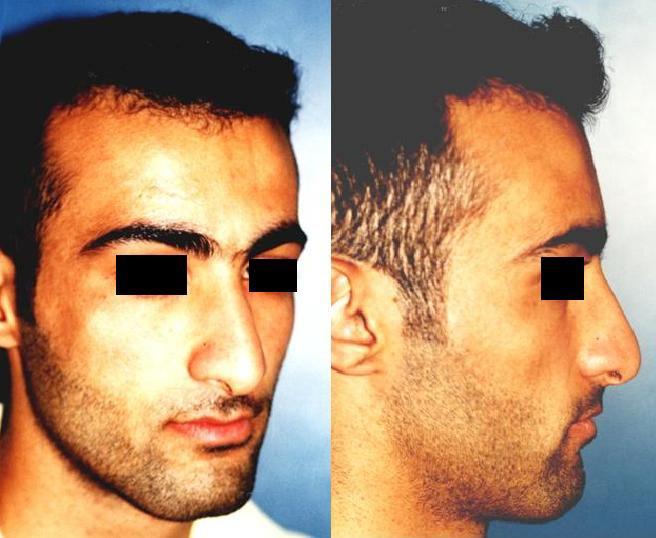 Unrecognizing the problem leads the surgeon to reduce the bridge (lower part of nose called columella) by shortening the size surgically.