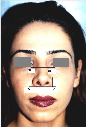 F. Face should be divided into three equal portions vertically marked by tip of the chin, tip of the nose, eyebrows and top of the forehead. This rule is entered into the model as the ratio of AB/BC.