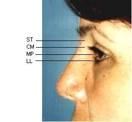 86) Ideally this ratio should be 1 for equilateral triangle. (Fig. 7) I. Mentocervical angle is defined as the angle defined by glabella pogonion line intersecting with menton cervical point line. J.