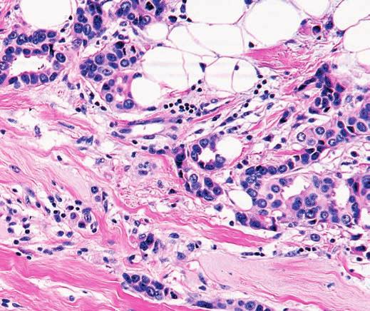 Anatomic Pathology / Original Article Table 5 Adjuvant Hormonal Treatment Compared With ER Status of the Primary Breast Carcinoma and Recurrences
