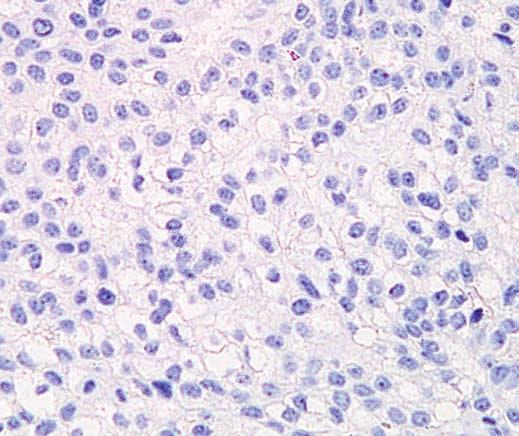 A B C D Image 2 Primary breast carcinoma of the infiltrative ductal (not otherwise specified) subtype (A, H&E, 200) with positive progesterone