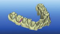 Invisalign Scanning ONSITE CHALLENGE Effectively capturing the mesial and distal interproximal areas when performing scans for Invisalign.