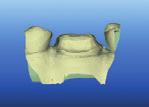 Using the Eraser Tool for Occlusal Reduction INSIDER INTELLIGENCE The Addition of